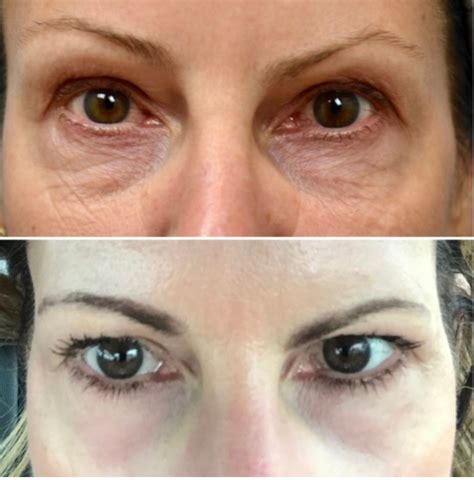 Morpheus8 Treatment Before and After. . Rf microneedling under eyes before and after